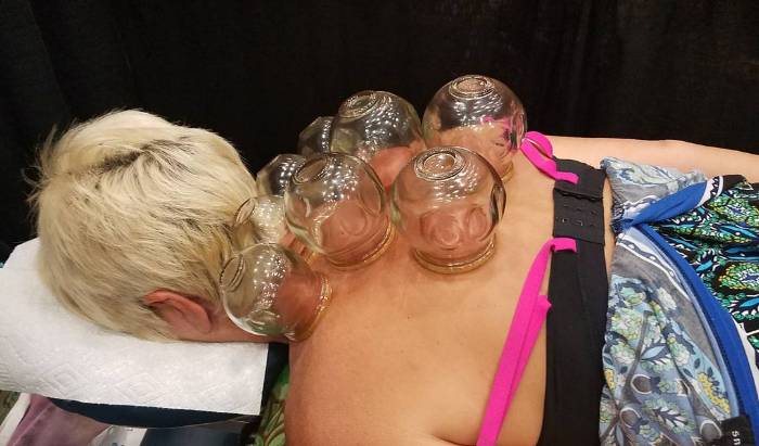 Fire Cupping image