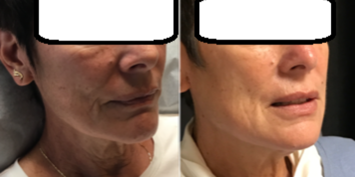 Voluma/Contour $600. Get 10 Botox/25 Dysport FREE in same visit!! - Partner Offer Image