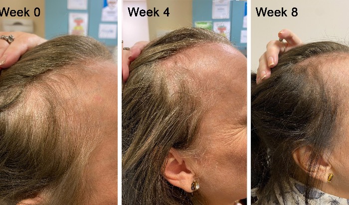 PRP with K-10 injections Hair Restoration $700 image