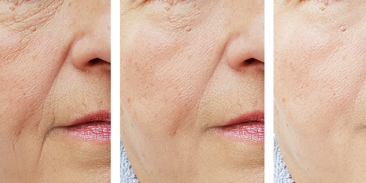 40% Off Anti-Aging Lasers (Limelight, Laser Gensis, Pearl Laser) For First Time Clients - Partner Offer Image