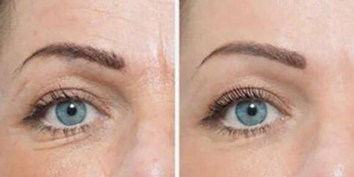 $560 for Plasma Fibroblast Skin Tightening at Kate's Beauty Room and Lash Bar (30% discount) - Partner Offer Image