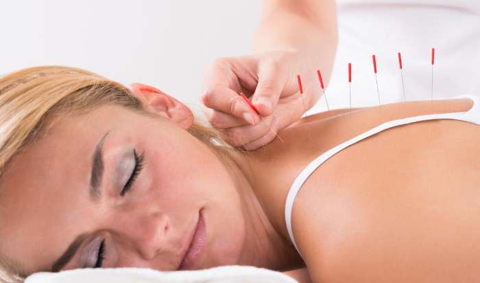 Acupuncture article image