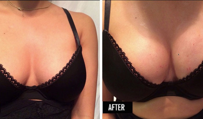 PRP Breast Lift $1500 image