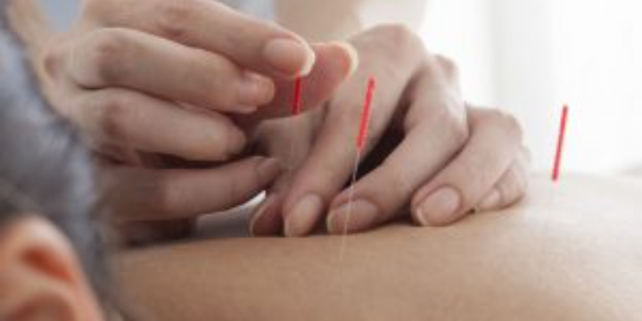 $15 Off Next Acupuncture Session - Partner Offer Image