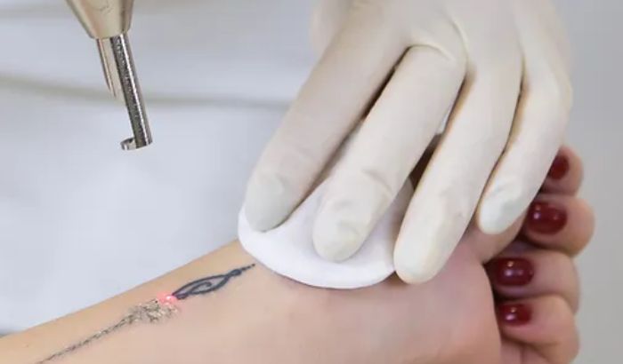 Tattoo Removal article image