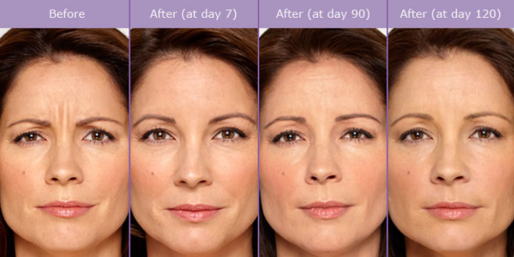 $179 for $179 for 20 units of Botox (NEW PATIENTS ONLY) at Handler Barry S MD: Cosmetic & Reconstructive Surgery (25% discount) - Partner Offer Image