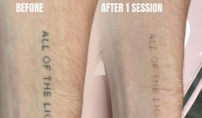 Laser Tattoo Removal — 40% OFF article image