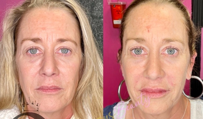 Ultherapy (Snob Facelift) $900 image