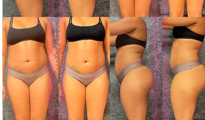 Three infrared laser lipo treatments with infrared sauna bed, body wrap and lymphatic massage  (Red Dot treatment) $450 image