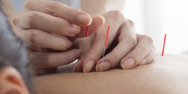 $25 OFF First Acupuncture Session - Partner Offer Image