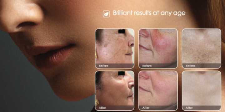 Free Consultation + 50% OFF your First IPL Skin Revitalization Facial - Partner Offer Image
