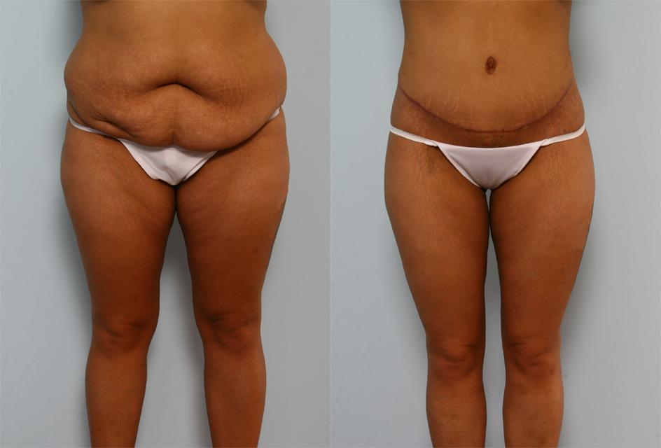 BodyLift Houston About Us Image