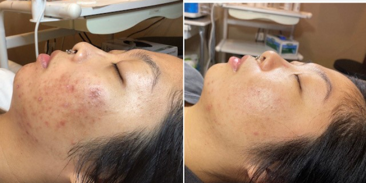 Acne or European Facial $75. Refer a friend for service & earn $$$ - Partner Offer Image
