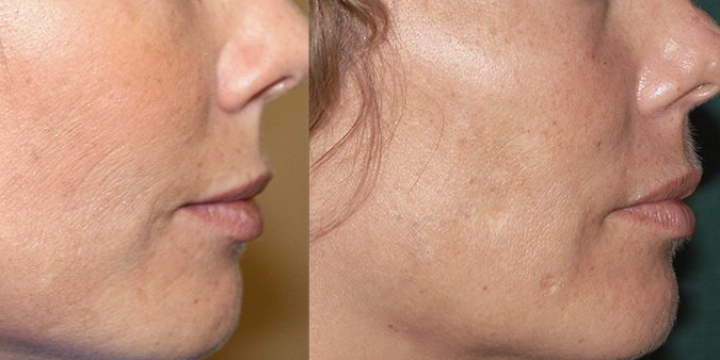 $798 for Radio Frequency Microneedling at On the Go VIP Spa - Partner Offer Image