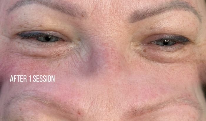 Laser PMU Removal — 40% OFF article image