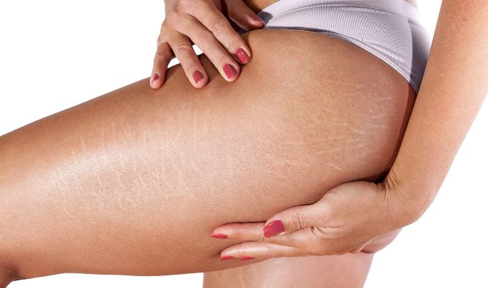 Can It Treat Stretch Marks? article image