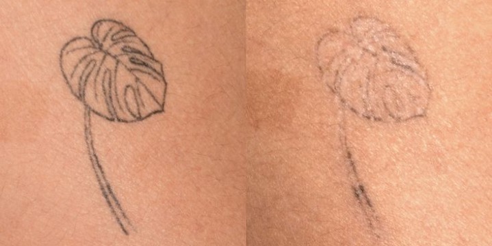 PROMO: $50 OFF Laser Tattoo Removal offer image