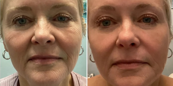 Melt-In Collagen 3 PACK SPECIAL - Get 1st FREE + 30% OFF on the next two Sessions! offer image