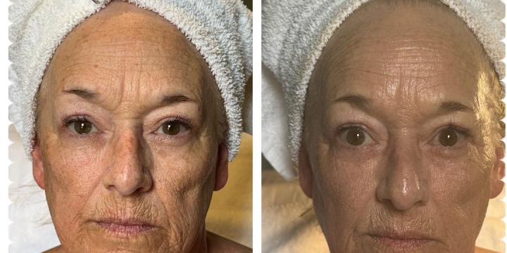 LIMITED TIME OFFER OVER 25% OFF NEEDLE FREE FILLER FACIAL - NOW $199 NORMALLY $275 offer image