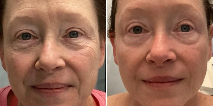 Melt-In Collagen 3 PACK SPECIAL - Get 1st FREE + 30% OFF on the next two Sessions! offer image