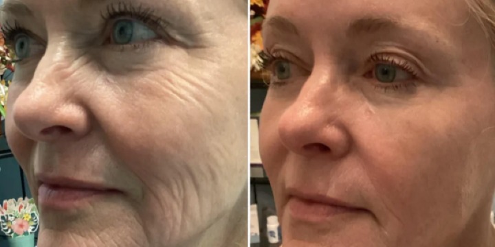 Melt-In Collagen SPECIAL - 5 Sessions $500 ONLY ($900 regular)! - Partner Offer Image