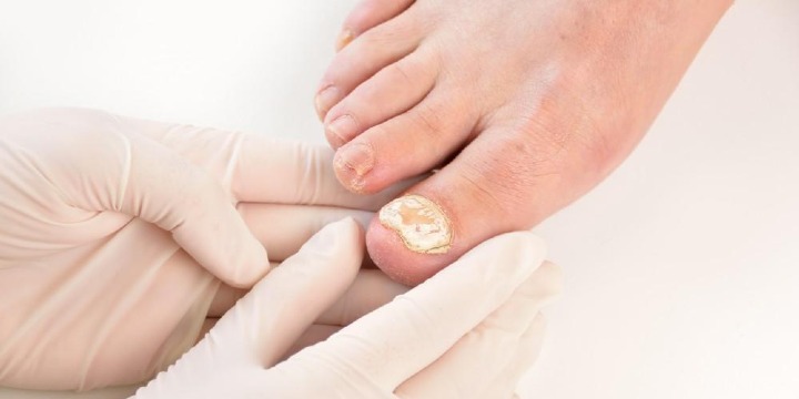40% OFF Toenail Fungus Treatment Package (May 5–10 ONLY!) 💥 offer image