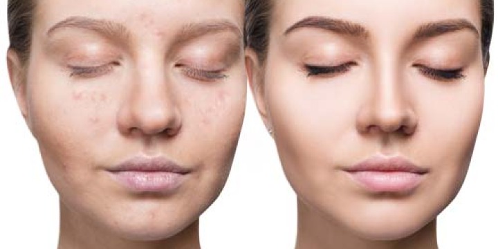 Skin Renewal Special: Microneedling & PRP – Only $400! offer image