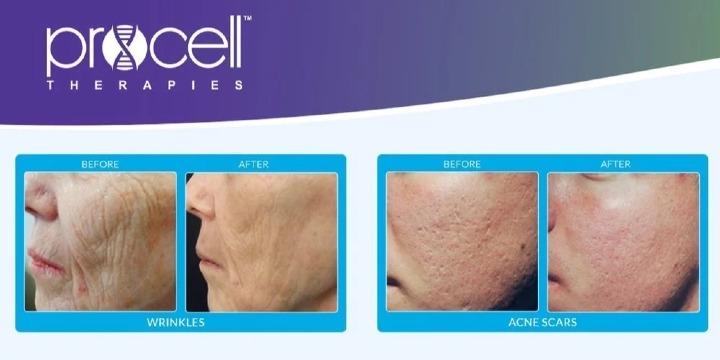 25% OFF NEW MD Strength ProCell Microchanneling offer image