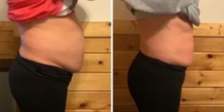 Endospheres Body Contouring SPECIAL – Buy 2, Get 1 FREE! offer image