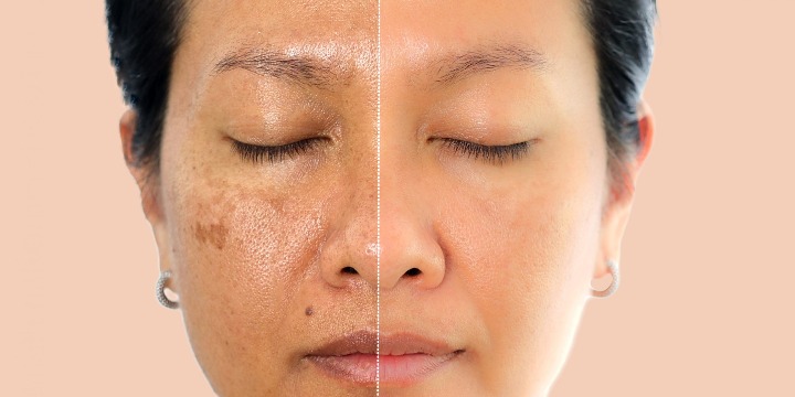 [BLACK FRIDAY PROMO] 25 % OFF Laser Skin Pigmentation Removal offer image